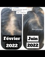 Anti-hair loss regrowth shampoo