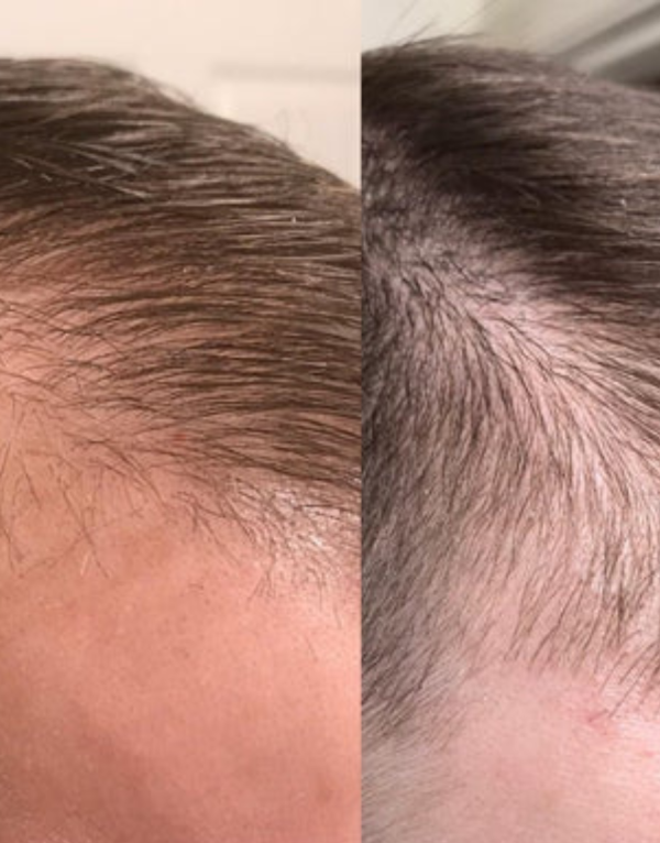 Extrem push roller 3 Extrem push roller